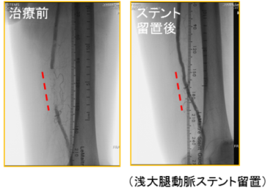 カテーテル治療