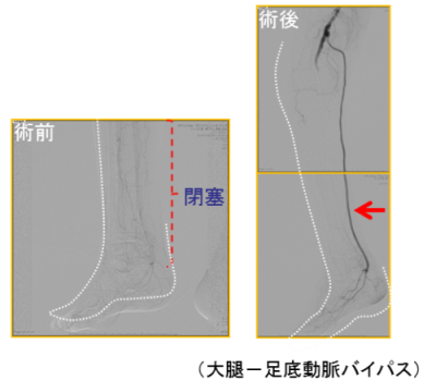 バイパス手術